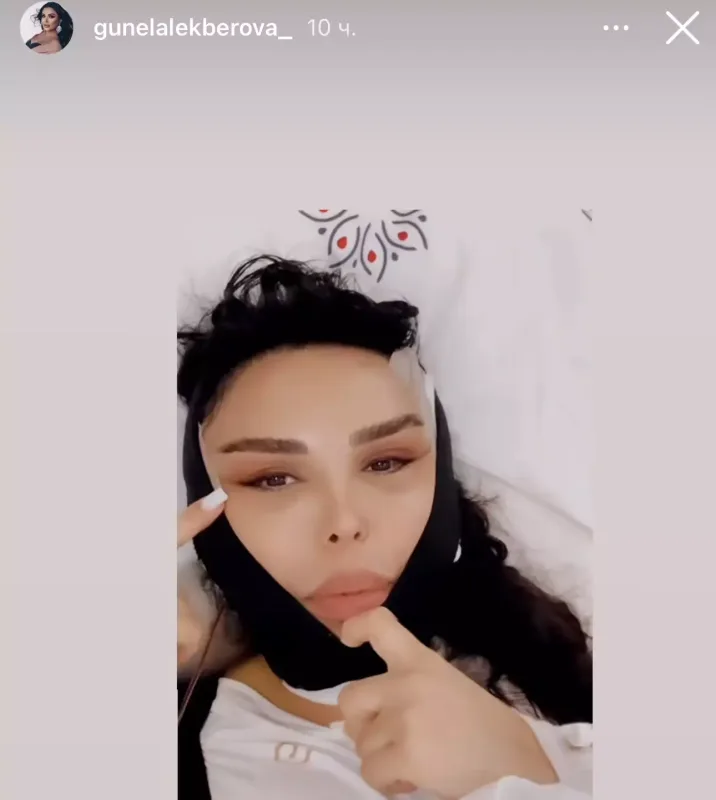 Günel plastik əməliyyatdan sonra...