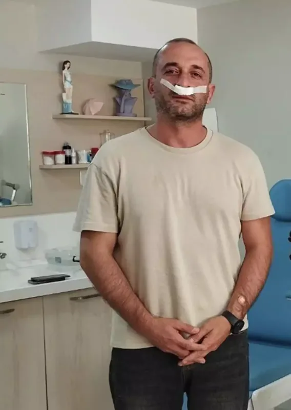 Hikmət burun əməliyyatı etdirdi