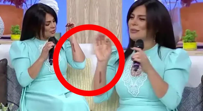 Aynurun qoluna nə olub?