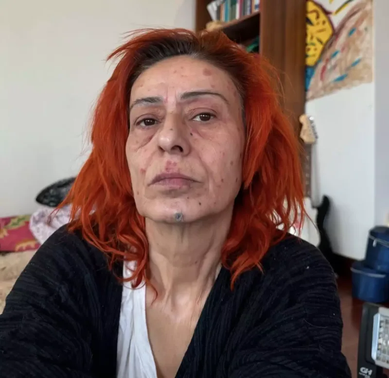 Saçını boyadı, üzü yandı