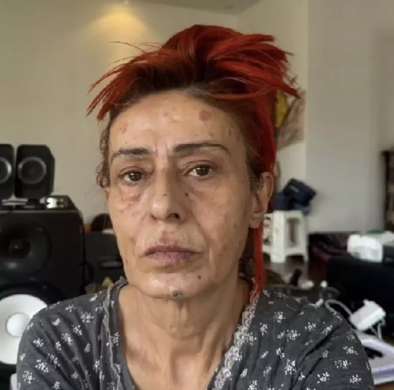 Saçını boyadı, üzü yandı