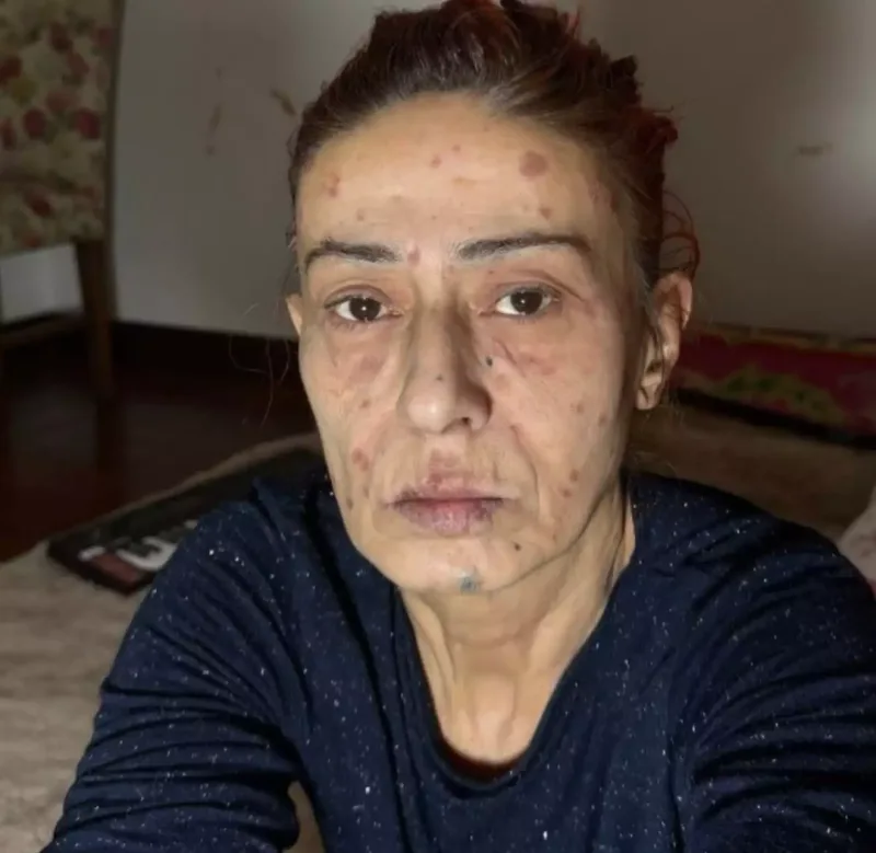 Saçını boyadı, üzü yandı