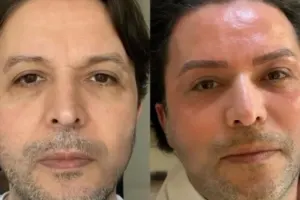 Nihat Doğan estetik etdirdi