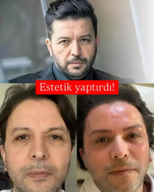 Nihat Doğan estetik etdirdi