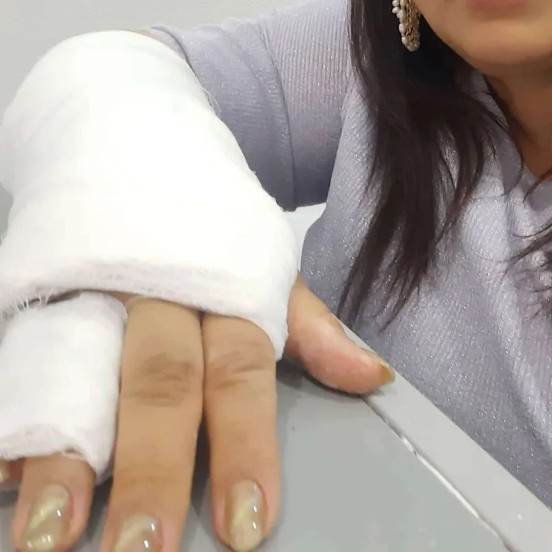 Aytən biləyini sındırdı - Fotolar