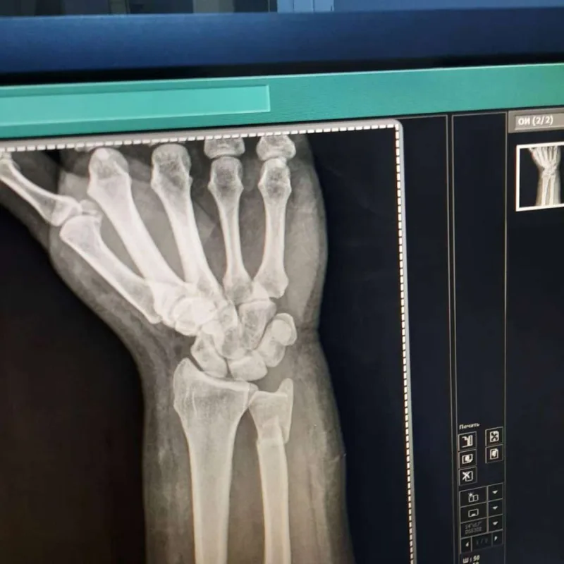 Aytən biləyini sındırdı - Fotolar