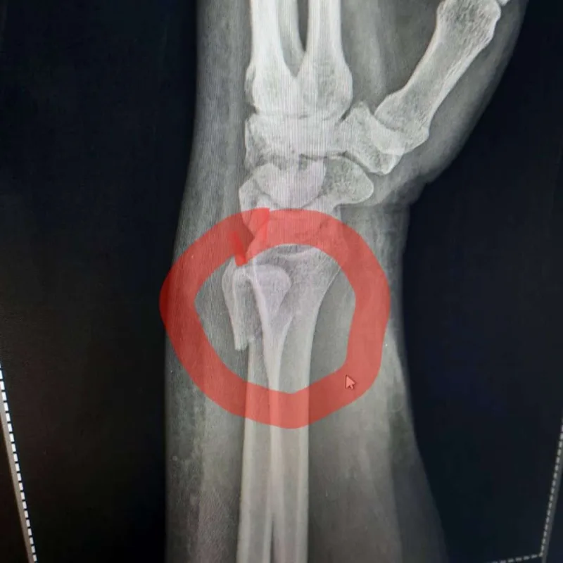 Aytən biləyini sındırdı - Fotolar