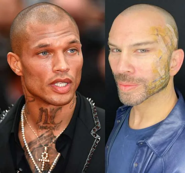 Berksanın estetik əməliyyatı lağa qoyuldu