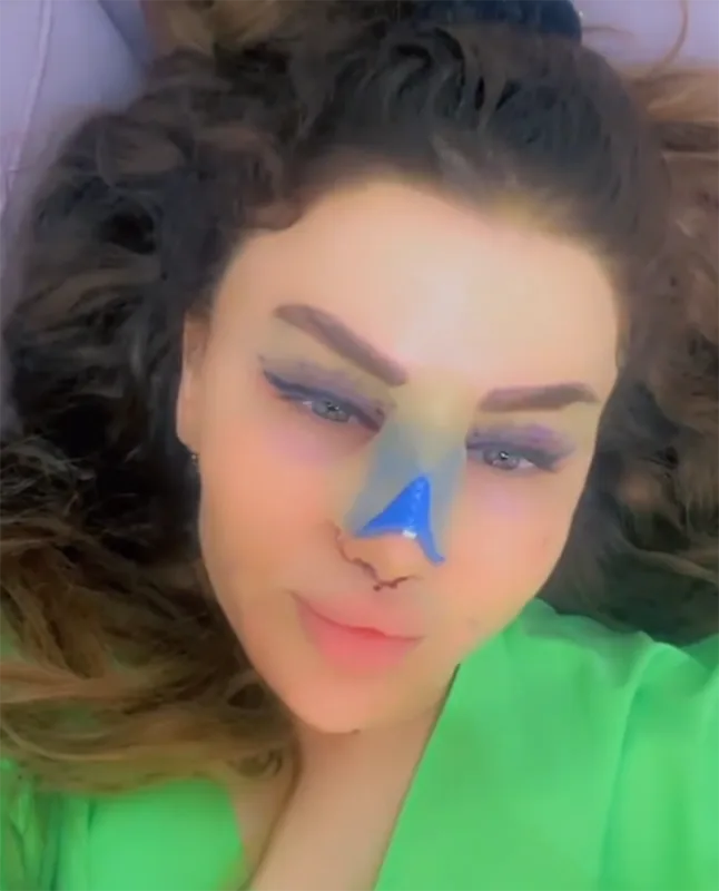 Fatimə plastik əməliyyatdan sonra...