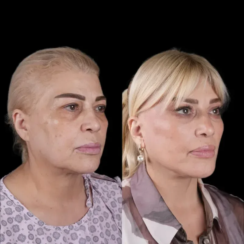 Mətanət İsgəndərli estetik əməliyyat etdirib