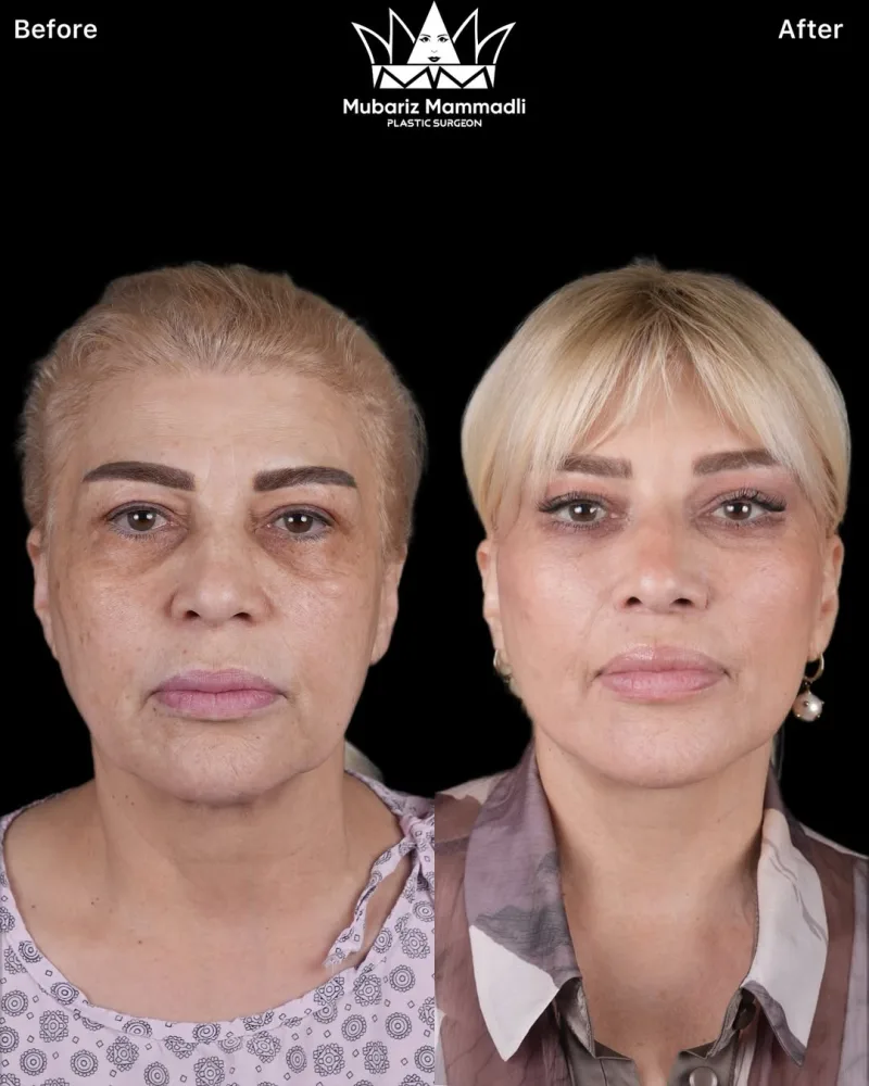 Mətanət İsgəndərli estetik əməliyyat etdirib