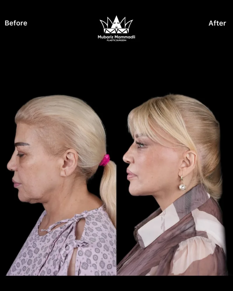 Mətanət İsgəndərli estetik əməliyyat etdirib