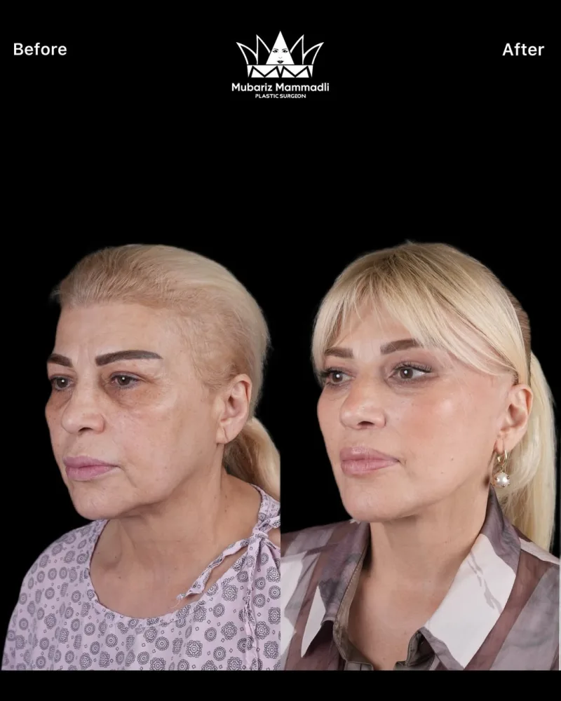 Mətanət İsgəndərli estetik əməliyyat etdirib