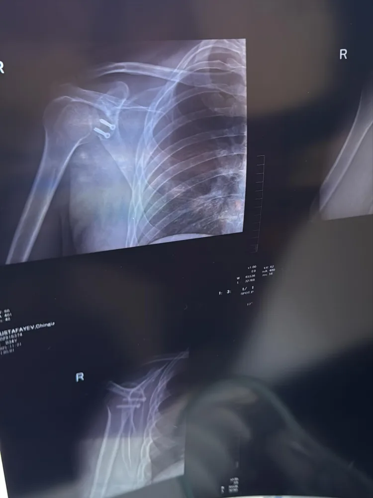 Çingiz əməliyyat olundu 