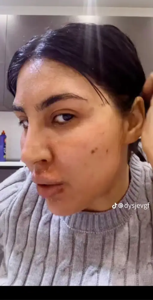 Tiktoker Ləmanın üzü yanıb