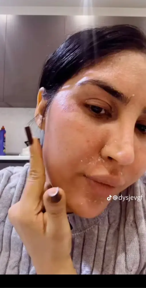 Tiktoker Ləmanın üzü yanıb