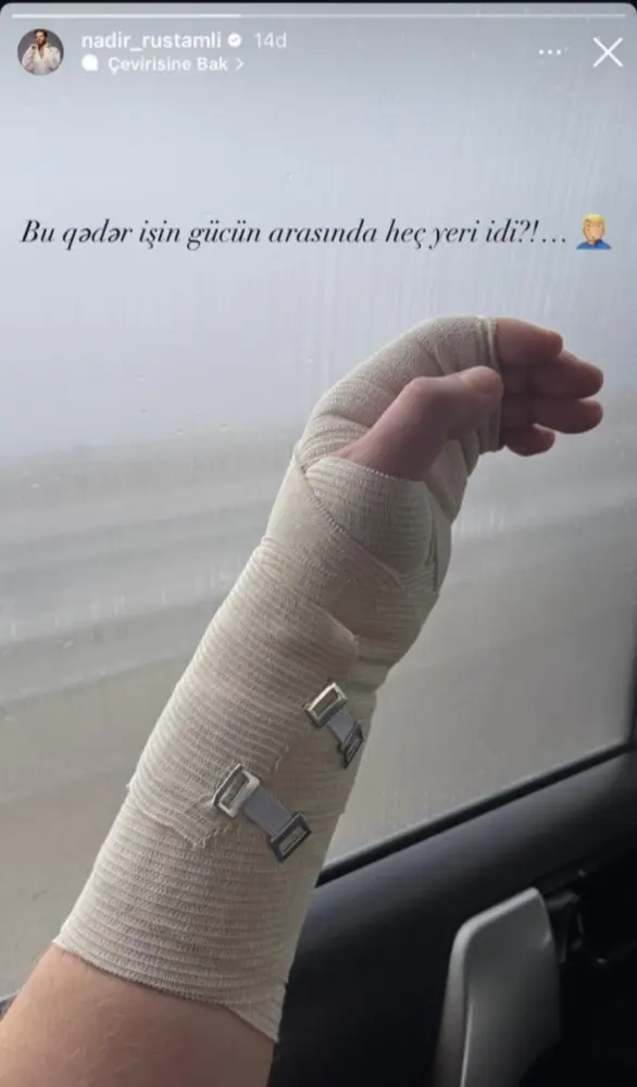 Nadirin əli zədələndi