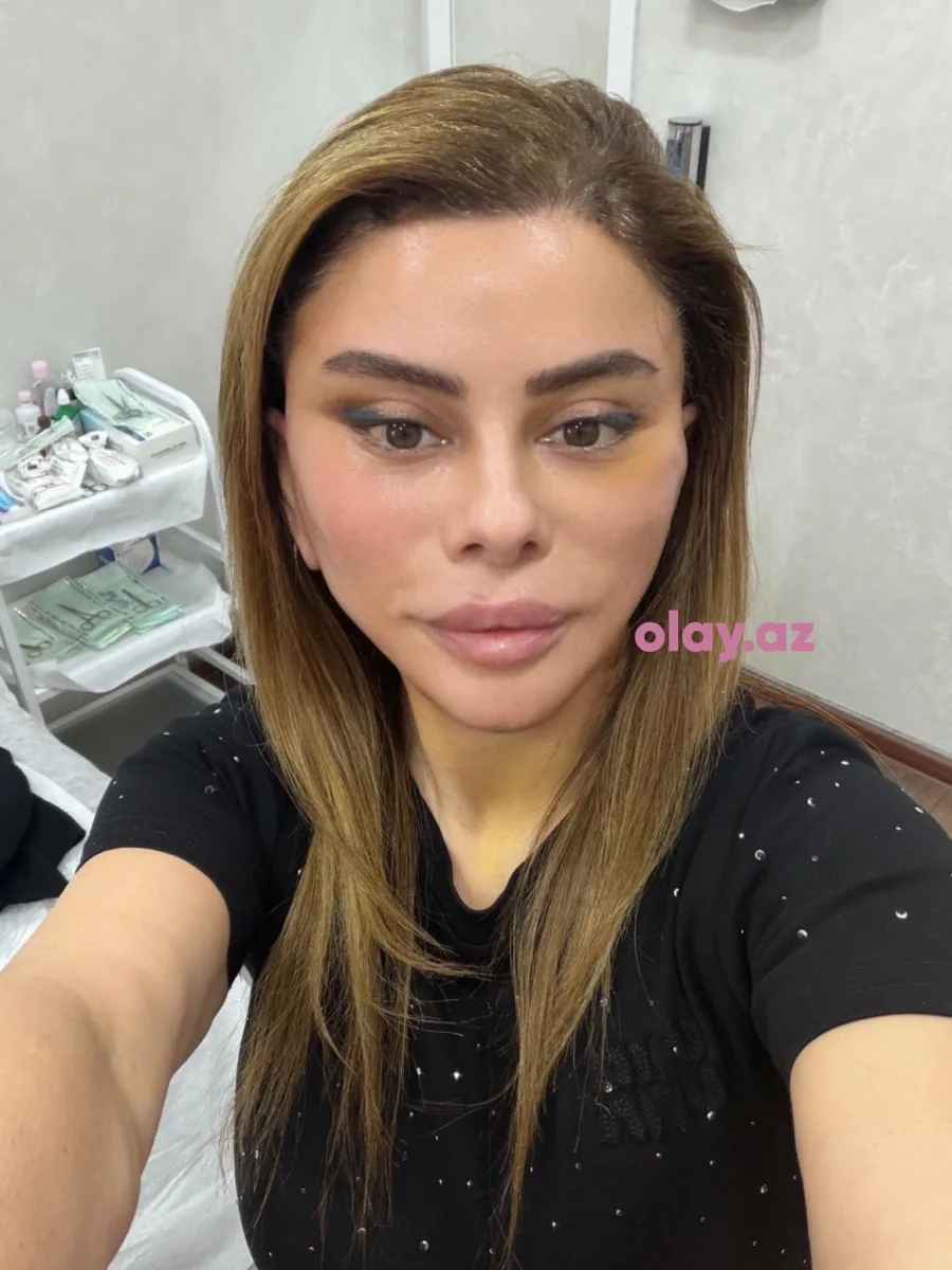 Üzgərmə əməliyyatı etdirdilər!