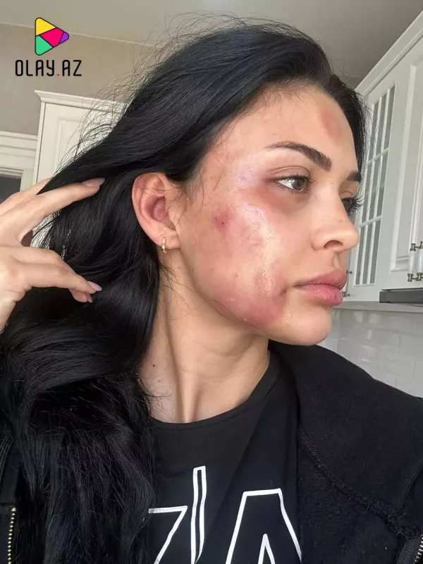 Razi Əliyeva şiddətə məruz qaldı