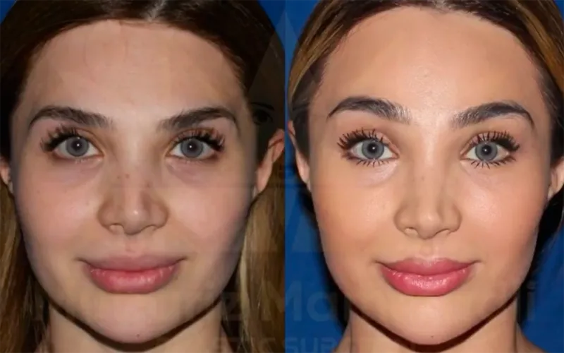 Ülviyyə Bellaya oxşamaq üçün estetik etdirdi