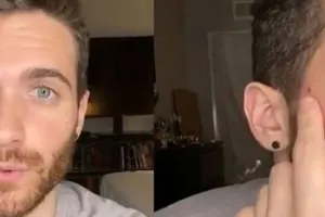 Amerikalı aktyor meymun çiçəyinə yoluxdu