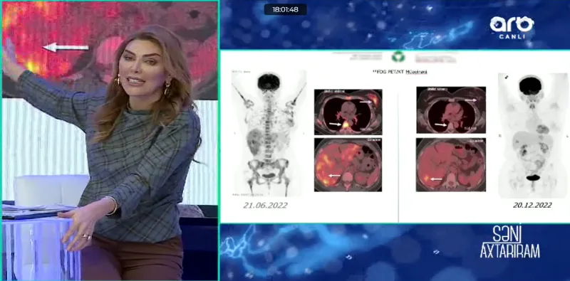 Aygün Bəylər xərçəngdən sağaldı