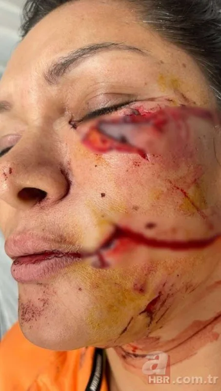 İt türk müğənniyə hücum edib, tanınmaz hala saldı