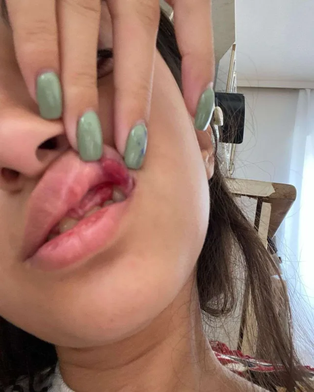 Sevgilisi tərəfindən döyülən Atlas əməliyyat olunacaq