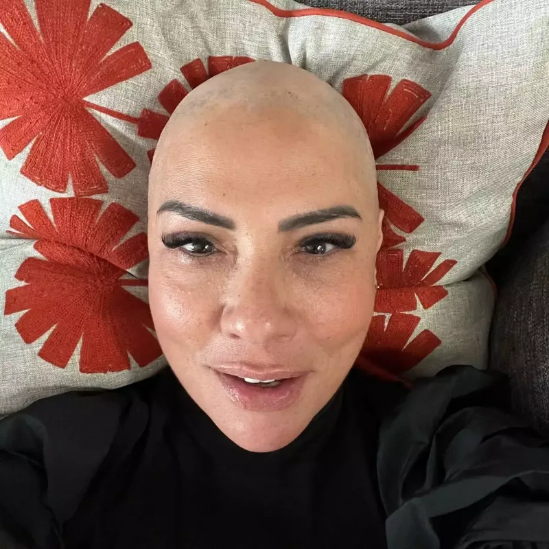 Keçəl fotosunu paylaşdı: “Gizlətmək getdikcə çətinləşir”