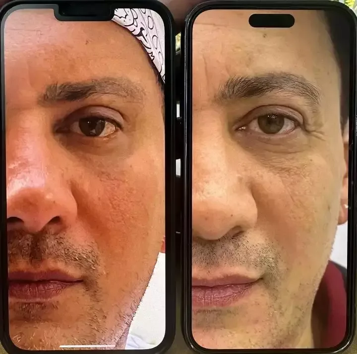 Sərxanın plastik əməliyyatdan sonrakı görüntüsü