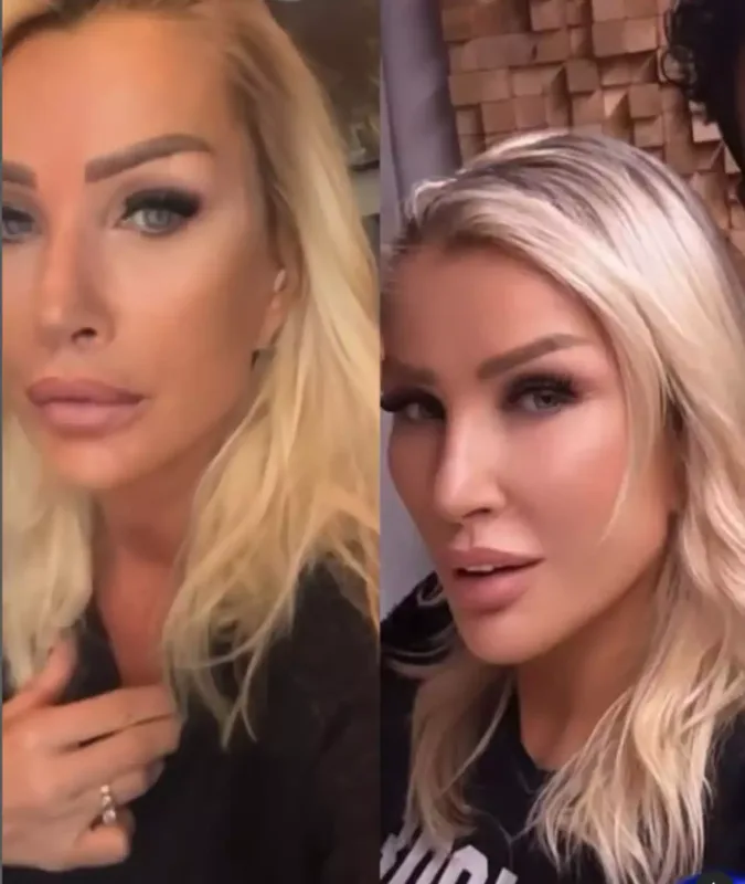 Üzünə sünnət dərisi vurdurdu