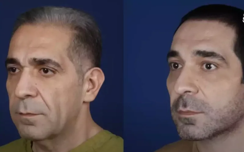 Estetiklə belə dəyişdi