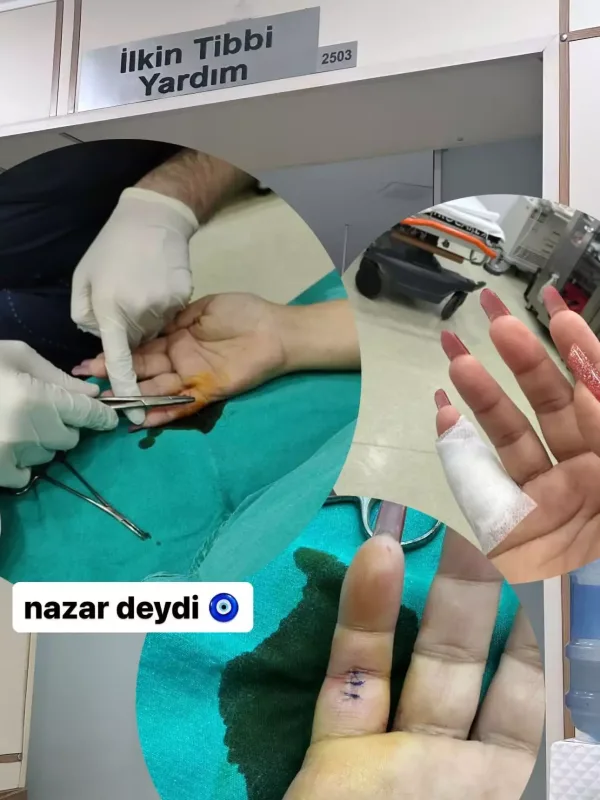 Xəyalənin barmağına tikiş atıldı