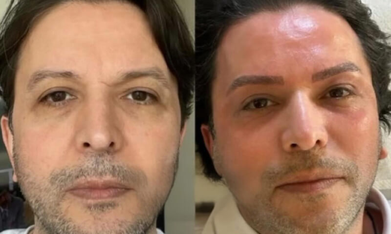 Nihat Doğan estetik etdirdi